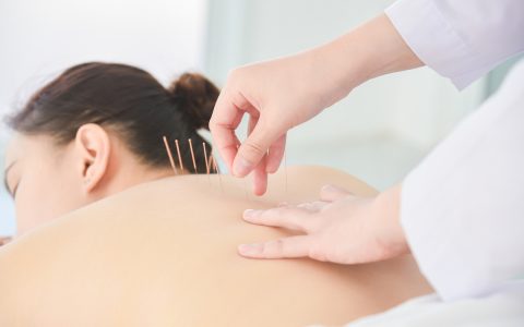 acupuncture treatment