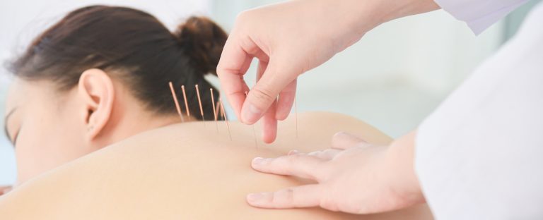 acupuncture treatment