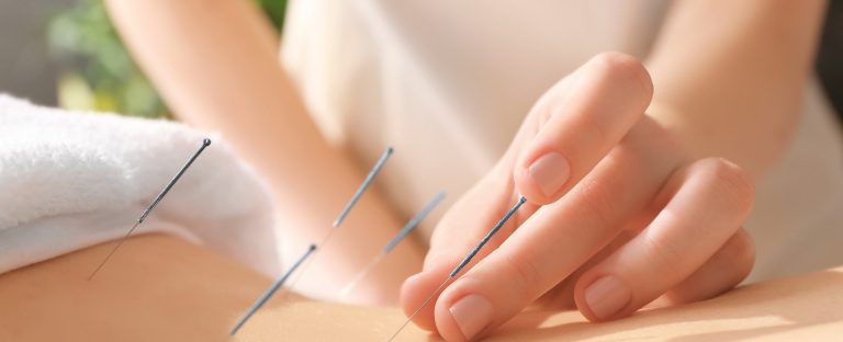 acupuncture treatments