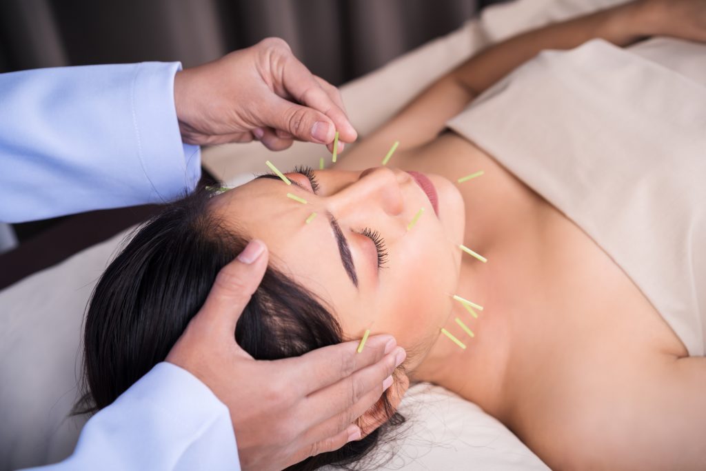 woman receiving acupuncture treatment