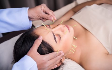 woman receiving acupuncture treatment