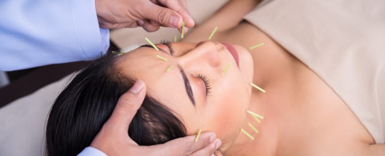 woman receiving acupuncture treatment